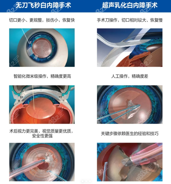 商丘尖峰眼科医院做白内障手术能报销吗