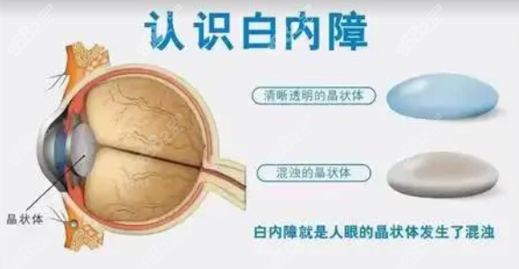 上海选择白内障手术医院及预约要点