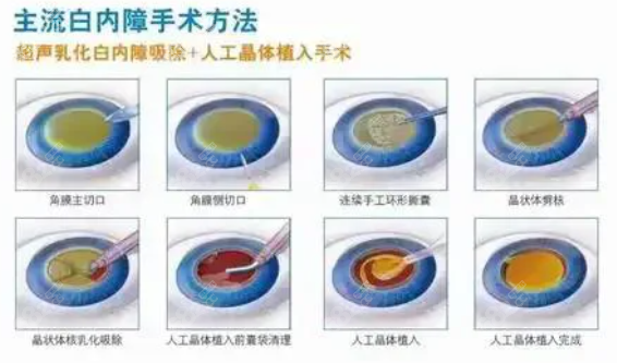 商丘做白内障手术如何选择医院及注意事项