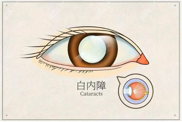 上海公立眼科医院做白内障手术预约方式