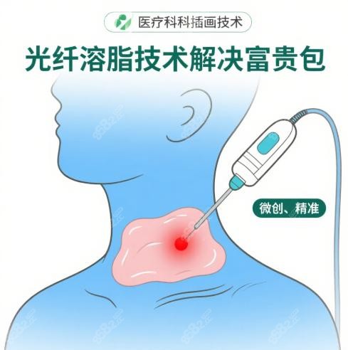 李方伟医生采用光纤溶脂技术解决富贵包更好