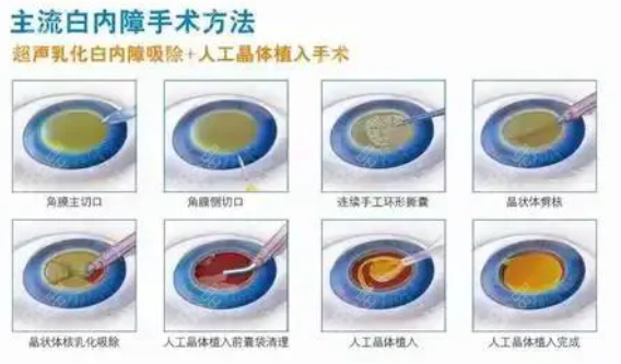 上海做白内障手术从预约到就诊的完整流程