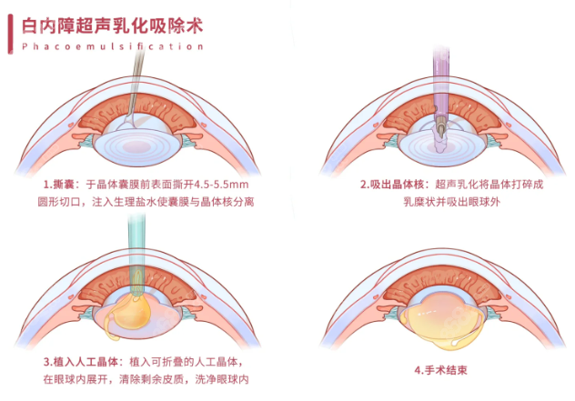 商丘尖峰眼科医院做白内障手术贵吗？花5000元重获光明不贵