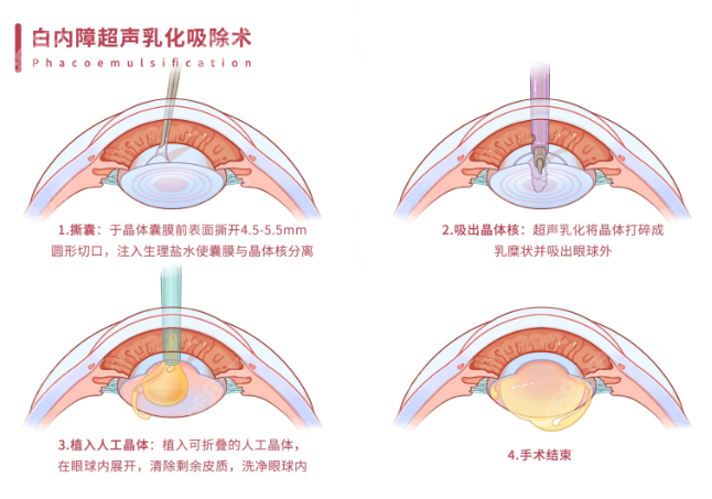 上海私立眼科医院做白内障手术预约方式