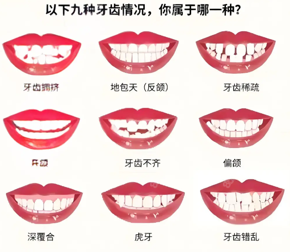舌側(cè)隱形矯正的優(yōu)勢與適宜人群