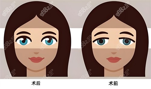 雙眼皮術(shù)后術(shù)前對(duì)比動(dòng)畫圖
