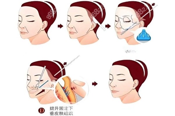 筋膜4(1).jpg