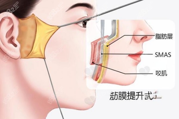 筋膜提升(1).jpg