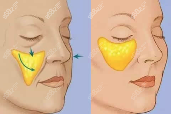 北京奧爾貝德整形陳鳳超醫(yī)生：助力面部年輕化的行家