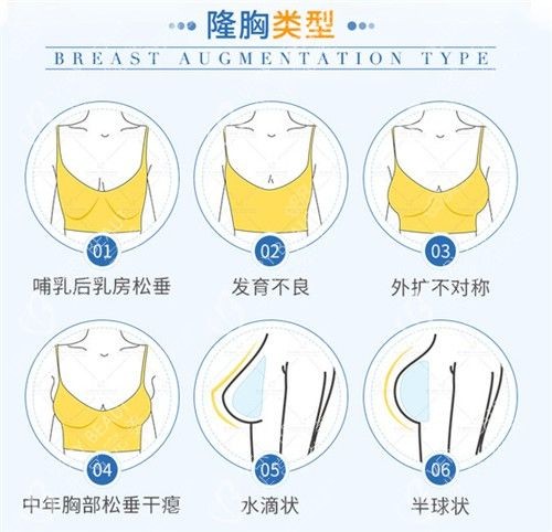 出彩医美十分钟隆胸预约流程