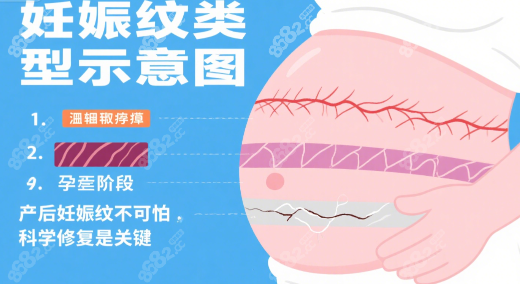 生完娃肚子留了妊娠纹