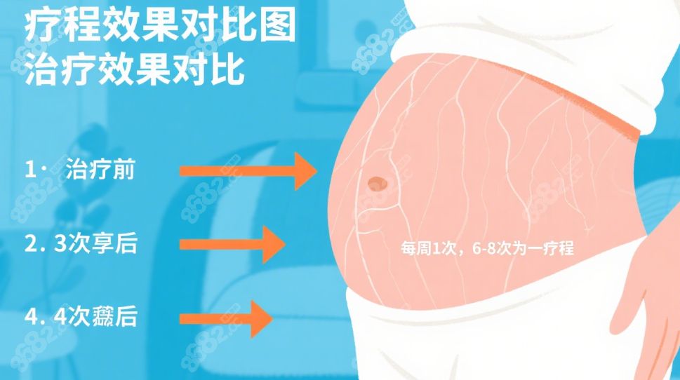 射频治疗要做几次