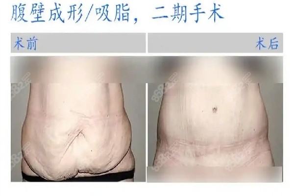 重庆松山整形医院腹壁成型详情