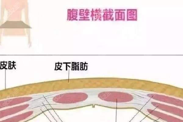 重庆华美整形腹壁成型详情