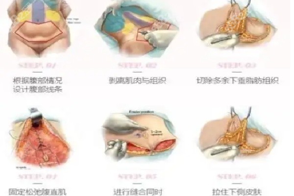 重庆星荣整形医院腹壁成型详情