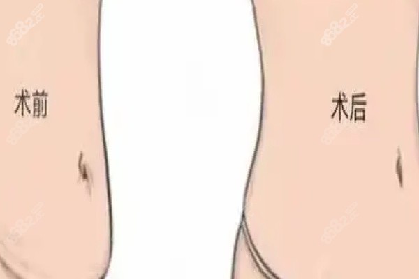 如何选择适合自己的腹壁成型医院