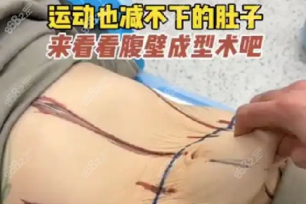 重庆当代整形外科医院腹壁成型详情