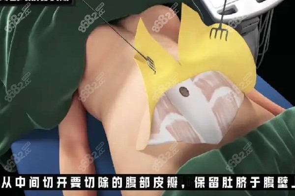 重庆腹壁成型好的医院有哪些