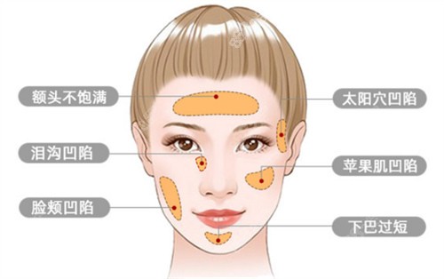 面部填充示意图