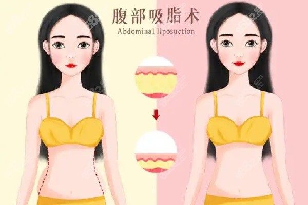 成都吸脂的醫(yī)院哪家好價格實惠 成都吸脂的醫(yī)院哪家好價格實惠