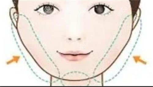 成都罗恩磨骨示意图