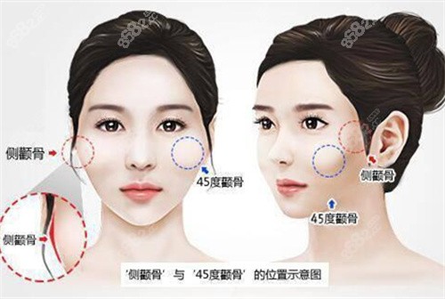 磨骨部位示意图