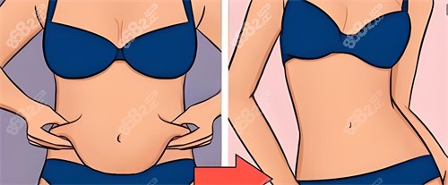 腰腹吸脂示意图