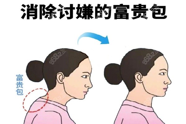 成都吸脂的醫(yī)院哪家好價格實惠 成都吸脂的醫(yī)院哪家好價格實惠