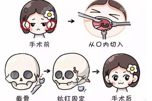 颧骨整形示意图