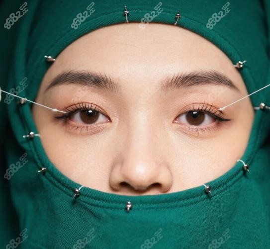 呂方中雙眼皮面診有費用嗎