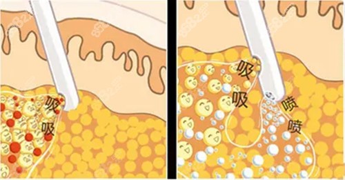 水動(dòng)力吸脂示意圖