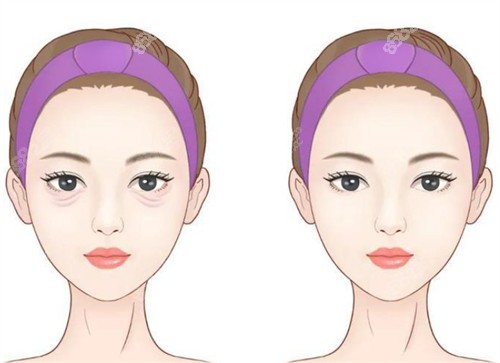 祛眼袋前后示意圖