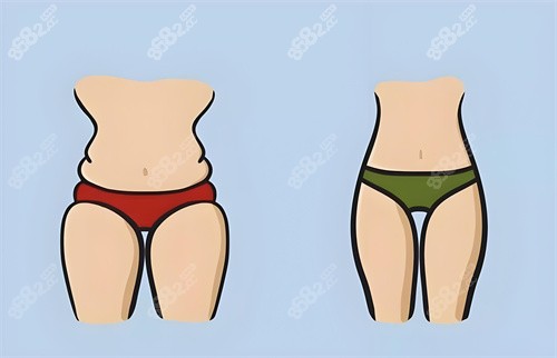 大腿吸脂示意圖