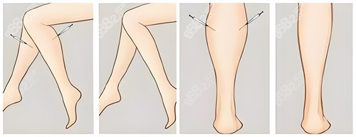 腿部吸脂示意圖