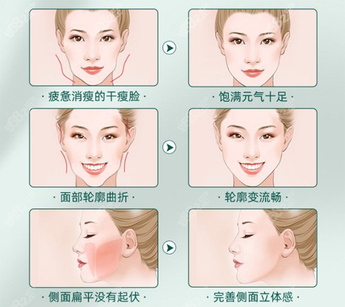 脂肪填充适应症