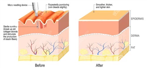 凹陷疤痕填充前后對比