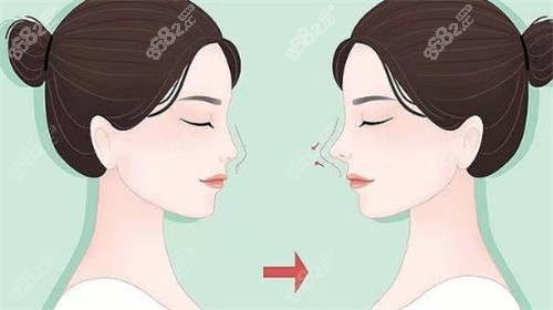 鼻修复对比