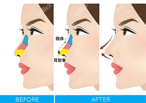 深圳藝星文豐隆鼻過程示意圖