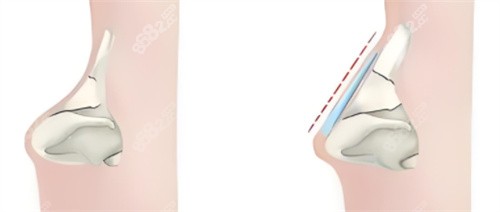 深圳藝星文豐隆鼻示意圖