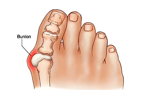 拇外翻原因动画演示图 拇外翻原因动画演示图