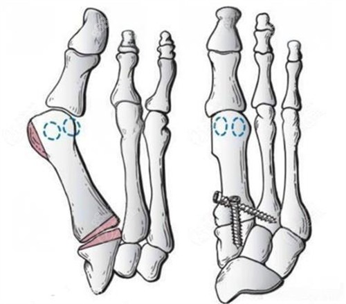 拇外翻微创手术动画演示图 拇外翻微创手术动画演示图