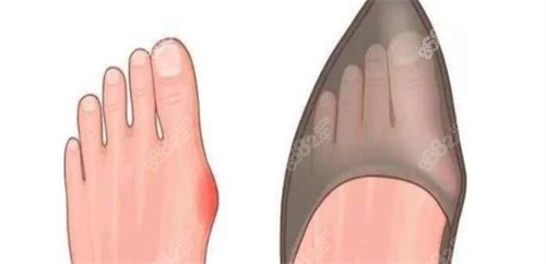 拇指外翻疼痛 拇指外翻疼痛