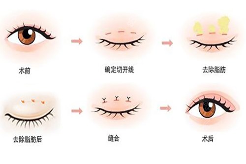 切开式双眼皮过程.jpg