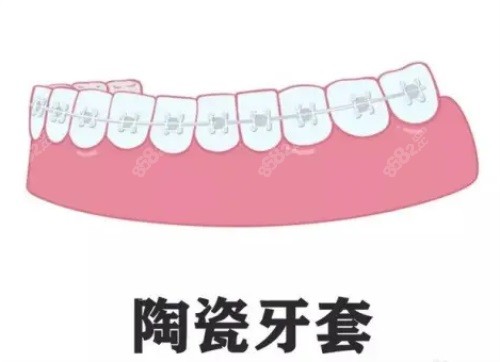 陶瓷牙套示意图.JPG