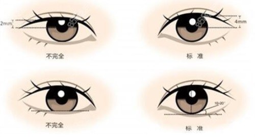 双眼皮示意图.JPG