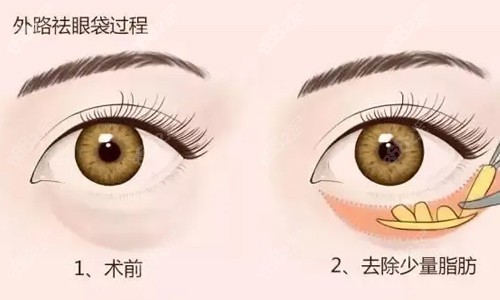 南京去眼袋哪个医院技术好？南京米兰柏羽和华韩奇致整形去眼袋肿胀期短|