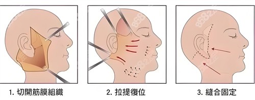 面部除皱拉皮法演示动画图.jpg