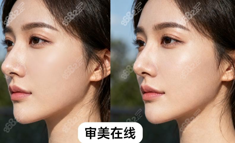 2025深圳隆鼻價格表