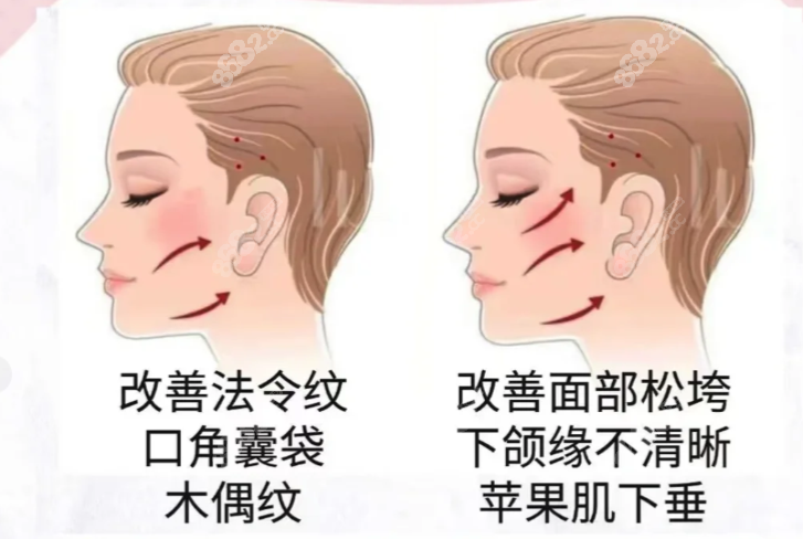 法国春天带韧带提升多少钱www.8682.cc