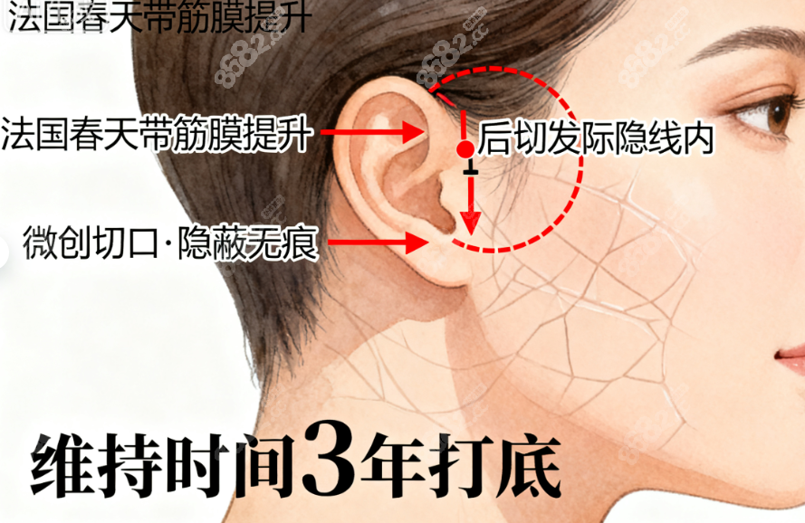 成都素美做法国春天带筋膜提升怎么样